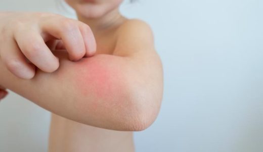 Niño se rasca su antebrazo, donde tiene un salpullido en la piel